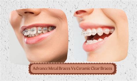 ceramic clear brackets vs metal brackets for braces|are aligners better than braces.